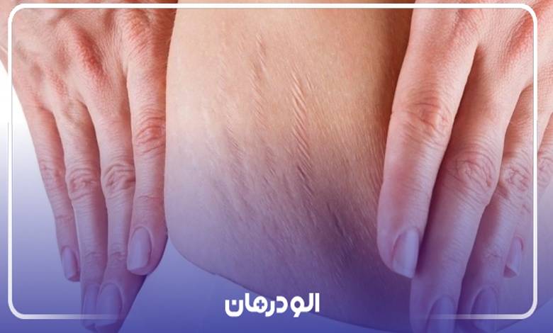 زمان مراجعه به بهترین دکتر درمان ترک پوستی در ایران