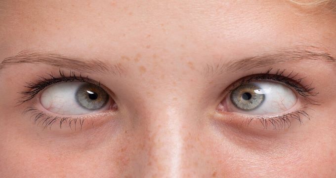 انحراف چشم چیست و چگونه درمان می شود؟