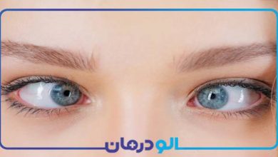 انحراف چشم چیست و چگونه درمان می شود؟
