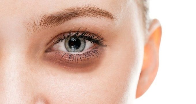 7 روش درمان خانگی گودی زیر چشم